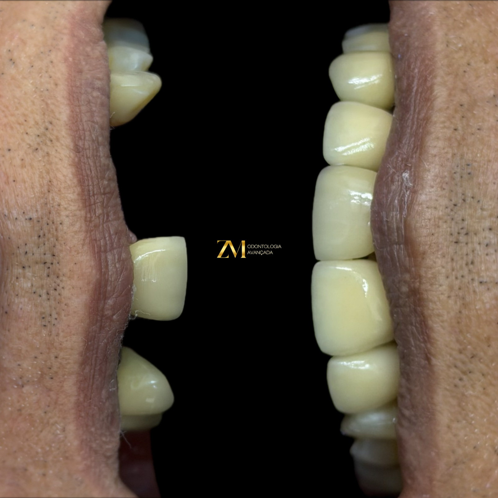 Antes e depois de tratamento com implante dentário na ZM Odontologia Avançada