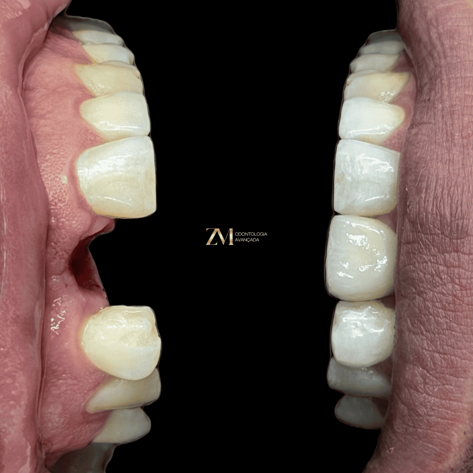 Implante dentário ZM Odontologia Avançada